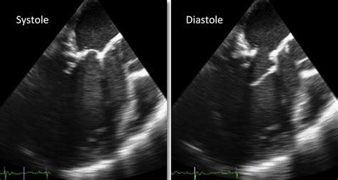 Echocardiographic Visualization And Quantification Of Mitral Complex