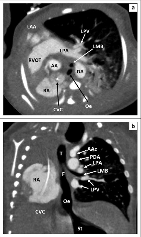 Computed Tomography Angiography Thorax In The Axial A And Oblique