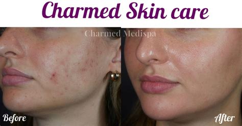 Results Gallery Charmed Medispa