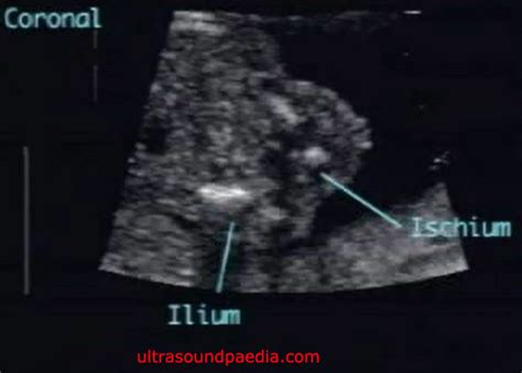 Amelia Ultrasoundpaedia