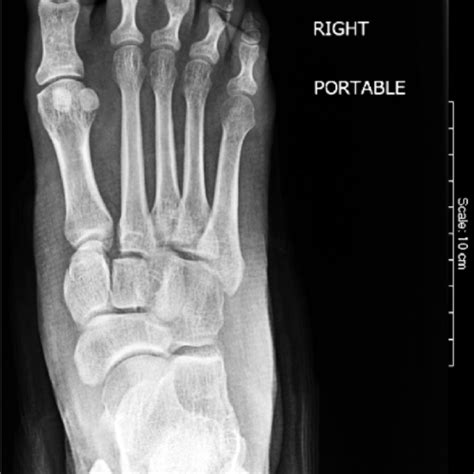 Lisfranc Fracture Dislocation Pre Reduction Radiograph Oblique View Download Scientific