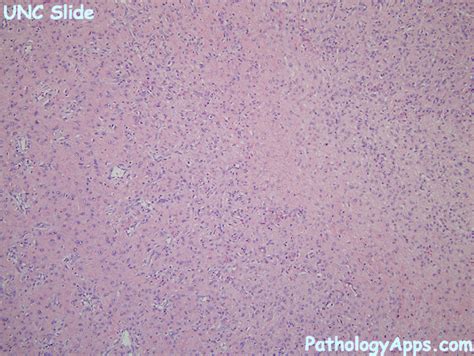 Angiofibroma Pathology