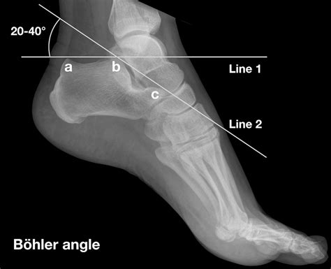 Böhler angle • LITFL • Medical Eponym Library