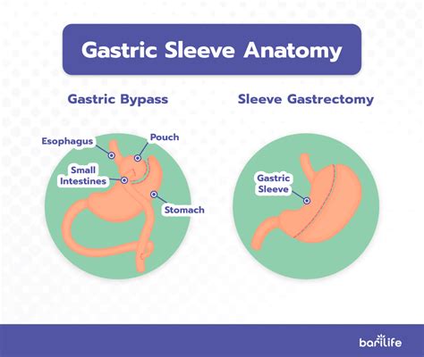 Gastric Sleeve Incisions Everything You Need To Know