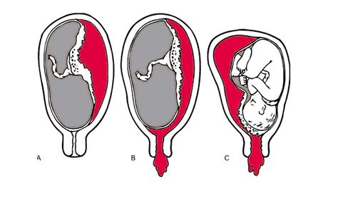 Nhau thai là gì các vấn đề về nhau thai mẹ bầu cần biết BvNTP