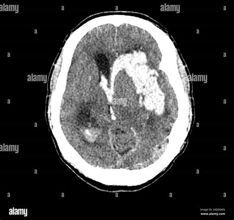 Accidente Cerebrovascular Y La Hemorragia Intracerebral Tomografía