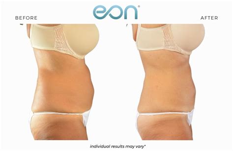 Eon Body Laser Contouring Fda Cleared For Reducing Unwanted Belly Fat