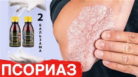 Как лечить псориаз. 39 лет страдала псориазам #нанобальзам # ...
