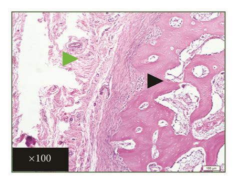 Histologic And Histomorphometric Analysis Of Treated Mandibular