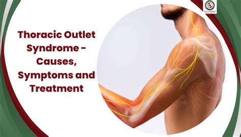 Thoracic Outlet Syndrome Causes Symptoms And Treatment