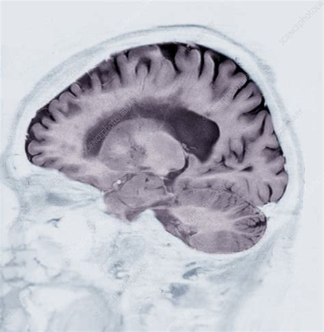 Alzheimer's disease, MRI brain scan - Stock Image - C038/8636 - Science ...