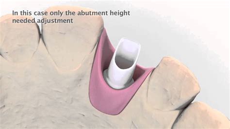 Astra Tech Implant System Laboratory Procedure Youtube