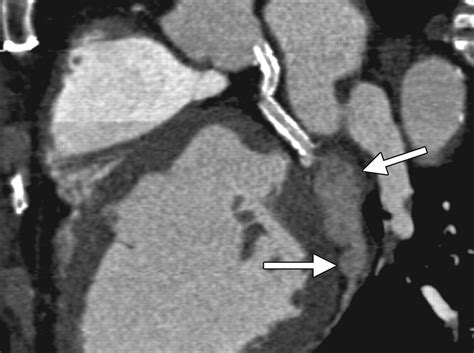 Coronary Artery Aneurysms And Ectasia Role Of Coronary Ct Angiography