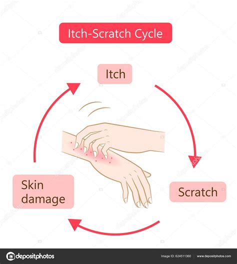 Ilustrasi Dari Tangan Dengan Tali Dry Dermatitis Dan Kondisi Eksim Vektor Stok Oleh ©mug5 624511360