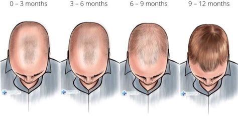 Understanding Finasteride Results Timeline And How Long It Takes To Work