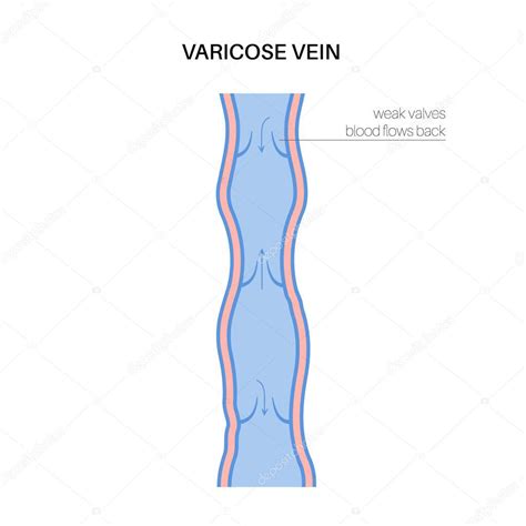 Concepto De Venas Varicosas Hinchaz N Y Dolor En Las Piernas Humanas