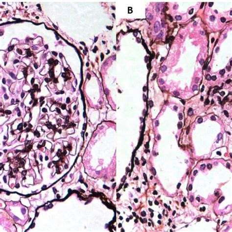 A One Glomerulus From The Renal Biopsy Of A Patient With Iga