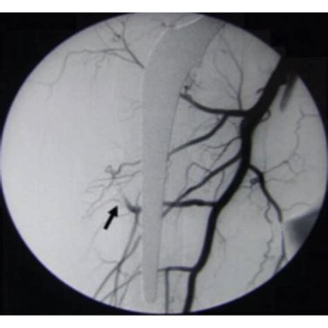 A Arteriography Showing The Pseudoaneurysm Pre Embolization B