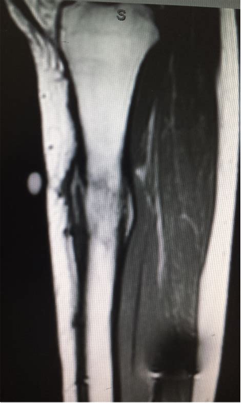 Osteomyelitis Adult Dr Mohamed Attia M D PhD