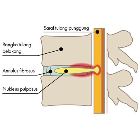 Disc Herniation Nlc Nonaka Lumbago Clinic