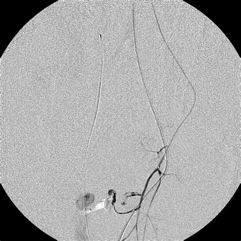 Trauma Embolization Case Albany Ir