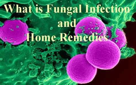 What is Fungal Infection and home remedies