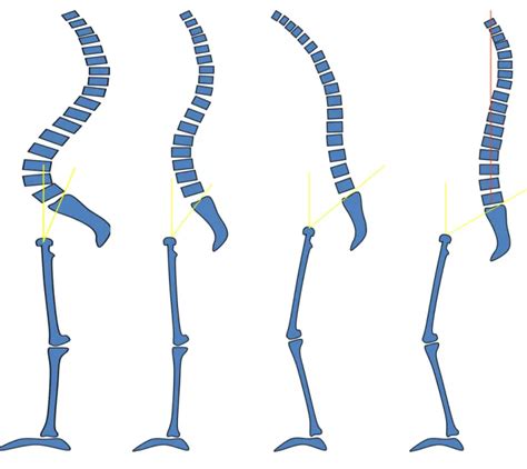 Classification Des Types De Dos Correction De L Quilibre Sagittal Du