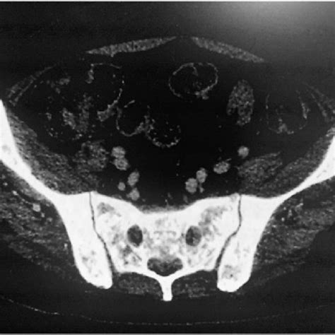 Ct Scan Of The Pelvis Suggested Osteoblastic Lesions In The Sacrum And