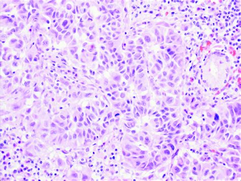 The Tumor Cells Contained Atypical Hyperchromatic Nuclei On Hande