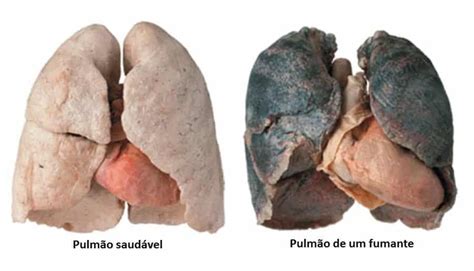 Veja Como Fica O Pulm O De Um Fumante Depois De Cigarros