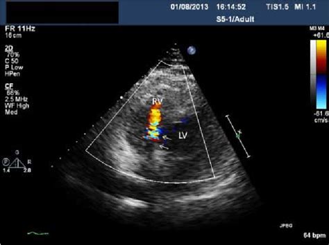 Figure From Surgical Management Of Left Ventricular Outflow