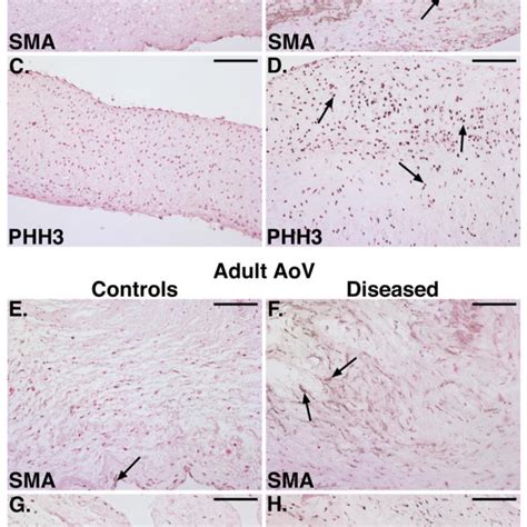 Activated Valvular Interstitial Cells Vic Are Present In Pediatric