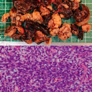 A Macroscopic Findings Of The Tumor B Hematoxylin And