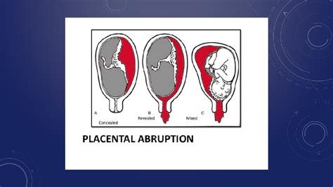 Sarah Awaisheh Antepartum Hemorrhage Anatomy Of The Uterus