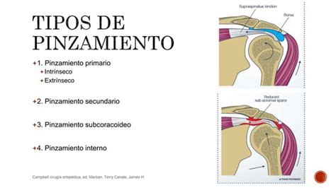 Sindrome De Pinzamiento Subacromial Pptx