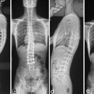 An Male Patient Aged 25 Years With 60 Left Thoracolumbar Curve A B