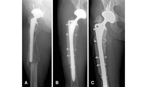 A Preoperative Radiograph Shows Diffuse Osteolysis Around The Femoral