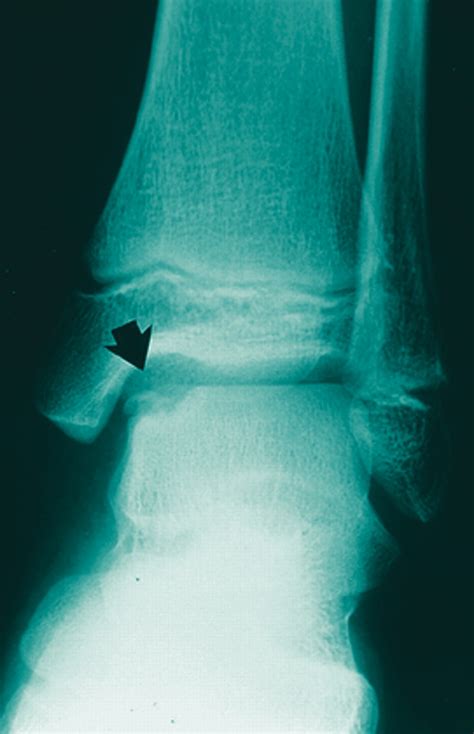 How To Address Osteochondral Lesions