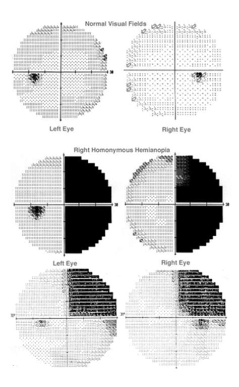 Hemianopsia Hom Nima North American Neuro Ophthalmology Society