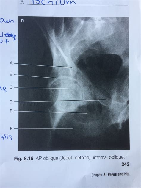 Rt Ch Ap Oblq Judet Method Internal Oblique Diagram Quizlet