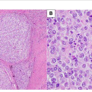 Patient A Sheets And Nests Of Neoplastic Cells Surrounded By