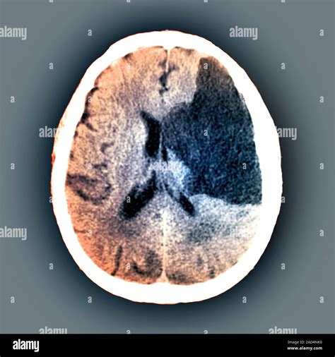 En La Apoplej A Cerebral Tomograf A Computarizada Coloreado De