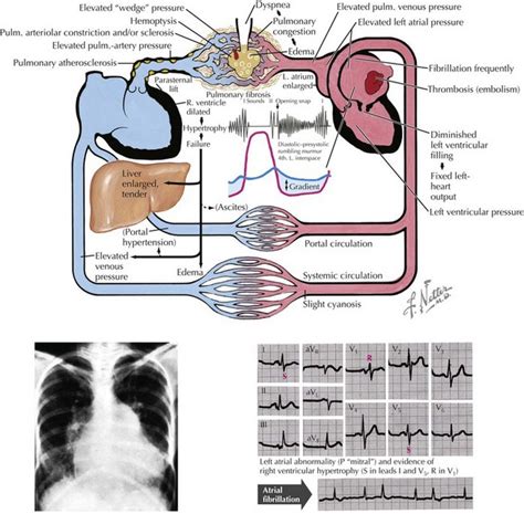 Pathophysiology Of Mitral Valve