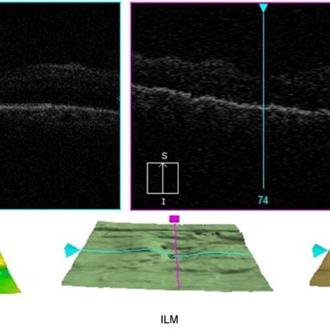 A DME case captured by ZEISS OCT machine. | Download Scientific Diagram