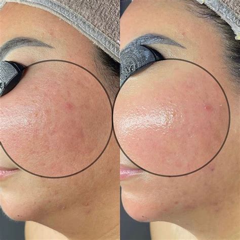 Hydro Dermabrasion All You Need To Know About The Hydrafacial