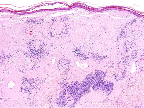 Localized Primary Cutaneous Nodular Amyloidosis In A Patient With Paraproteinemia Actas Dermo