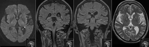 Radiology Mri Tail Of Caudate Nucleus Infarct