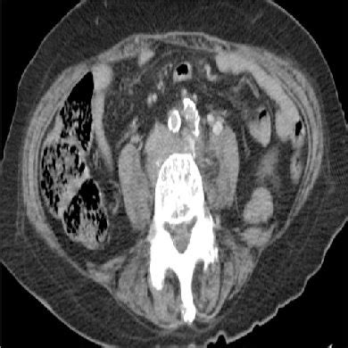 Characteristics of Patients Suffering Inguinal Abscess | Download Table