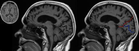 Parieto Occipital Sulcus