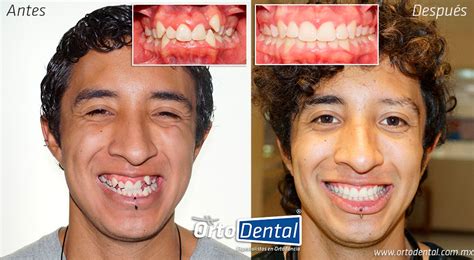 Increíbles Cambios Faciales con Ortodoncia OrtoDental Ortodoncista